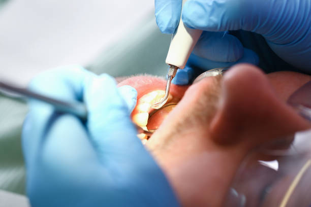 Best Emergency Dentist for Lost Fillings or Crowns in South Brooksville, FL